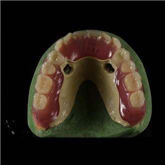 „Peek Framework“ protezas