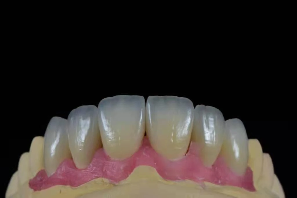 Ultra-Thin Feldspathic Veneers (0.3mm) Ultra-Thin Feldspathic Veneers (0.3mm)