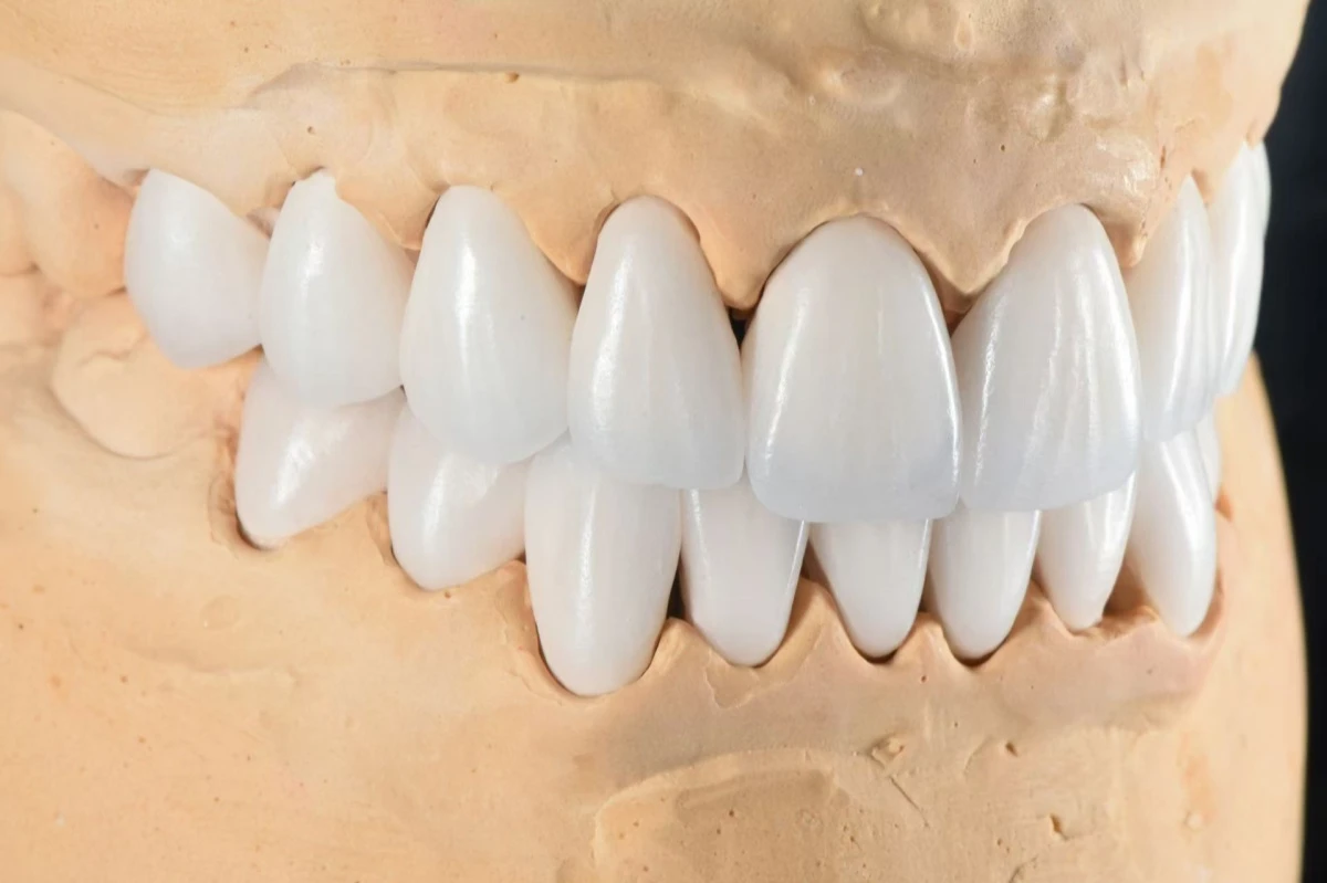 Custom feldspathic veneers showing natural blue-white opalescence Custom feldspathic veneers showing natural blue-white opalescence