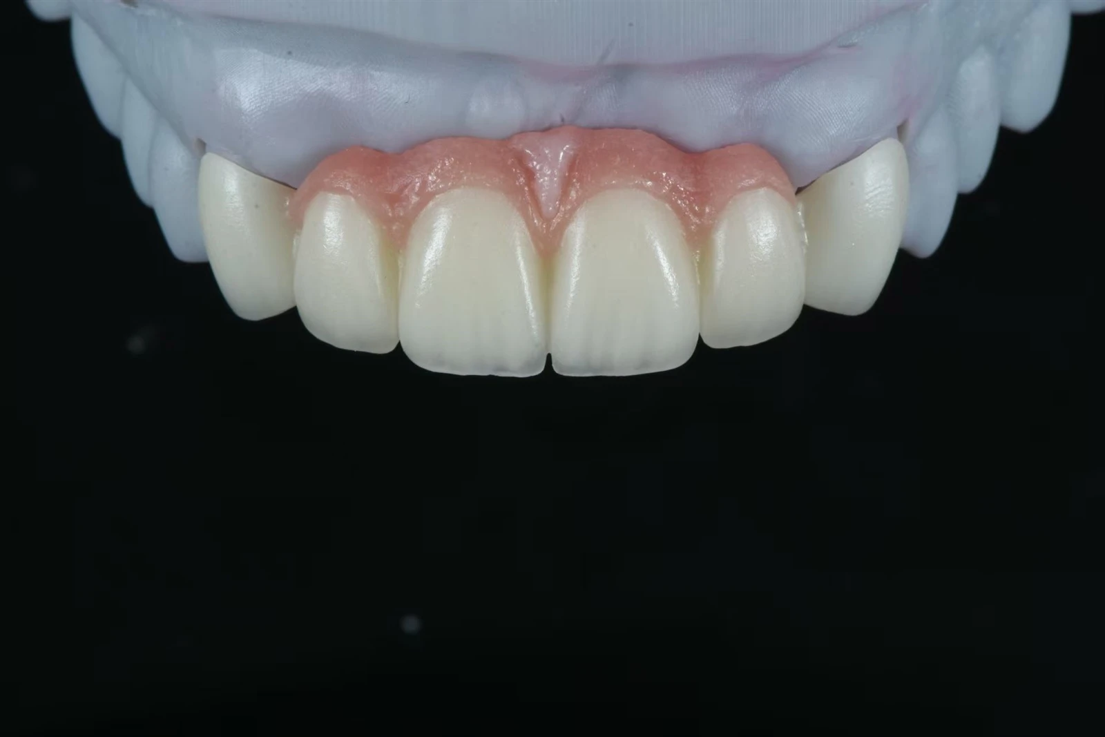 Implant bridge with pink ceramic gingiva full-arch restoration Implant bridge with pink ceramic gingiva full-arch restoration