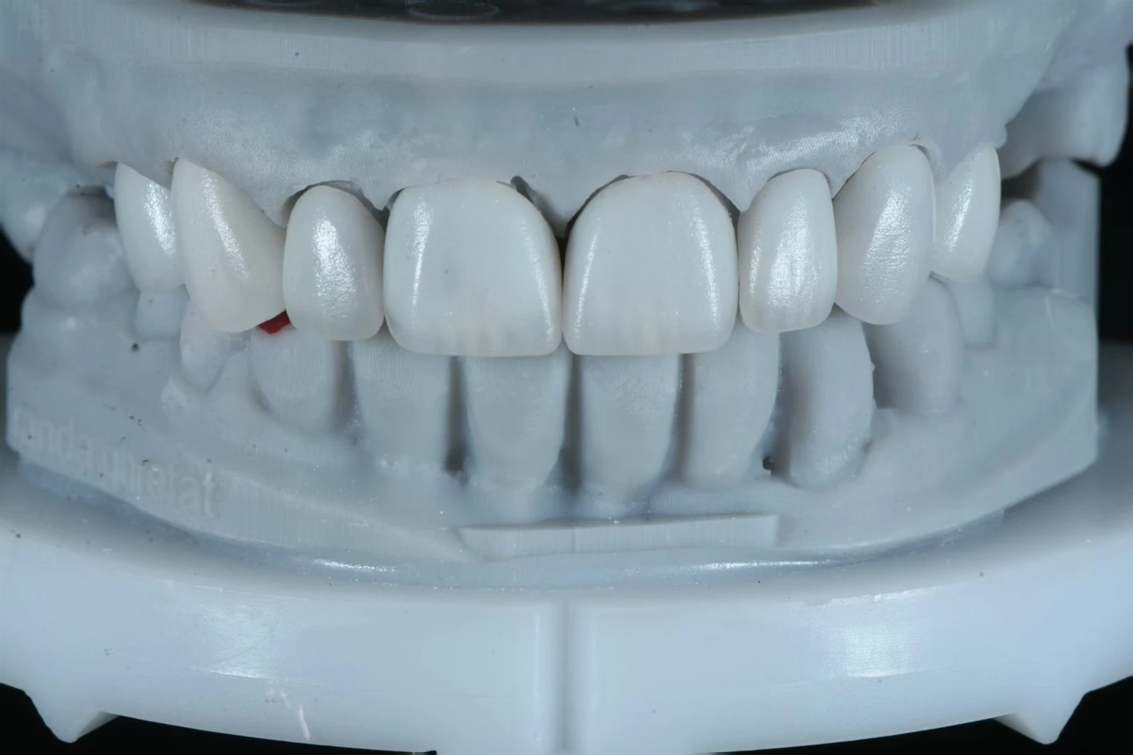 Conservative E.max Layering Veneers for Anterior Aesthetic Restorations Conservative E.max Layering Veneers for Anterior Aesthetic Restorations