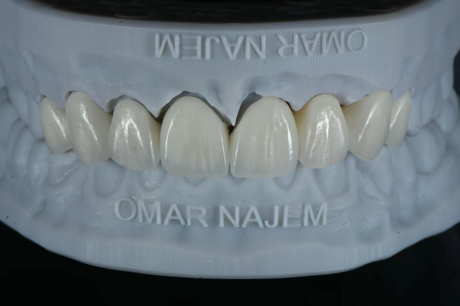 Minimal-Prep E.max Layering Veneers with Controlled Facial Contour Minimal-Prep E.max Layering Veneers with Controlled Facial Contour