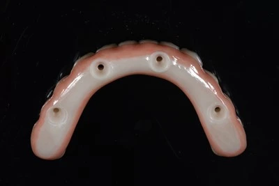 Pilnas-Arkinis cirkonio implantų tiltas