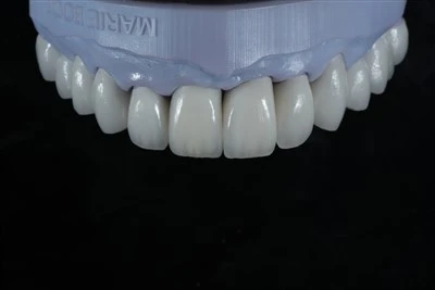 IPS E.max Fanera