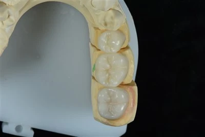 Minimaliai invaziniai E.max įklotų sprendimai